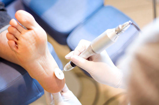 Procedimento de podologia na sola do pé, feito com luvas e lixa elétrica